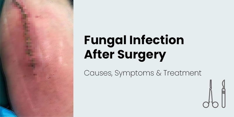 Fungal Infections After Surgery: Warning Signs, Causes, Treatment & Prevention Tips